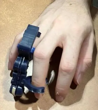 Prosthetic on hand